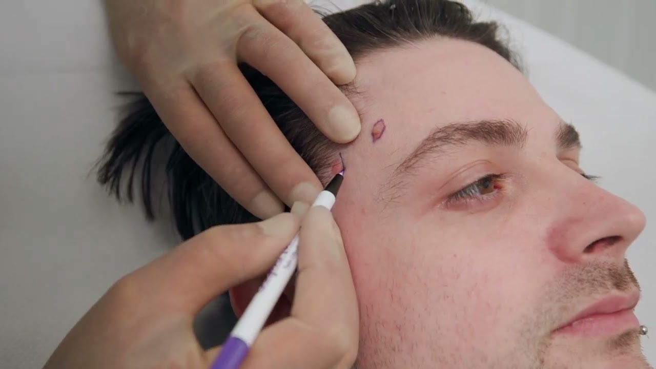 The Beauty Gurus   Moles Surgery under local anaesthetic