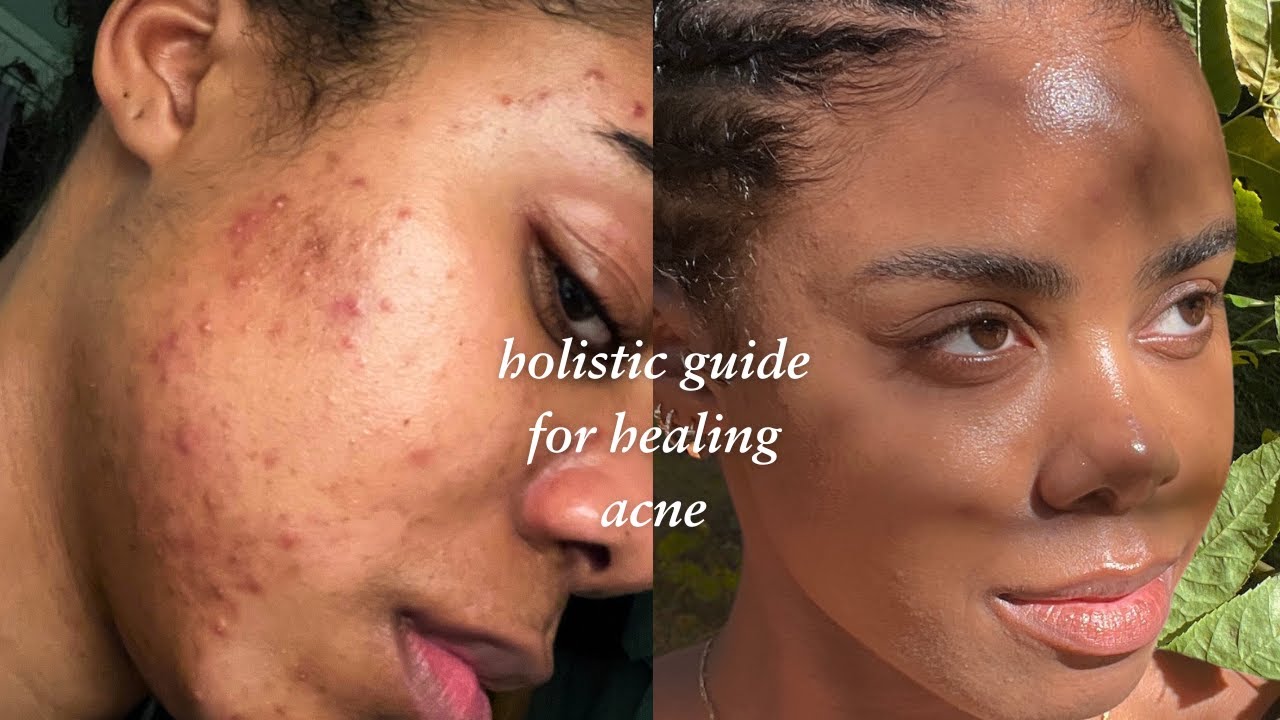 How to *actually* heal your acne (full holistic guide)