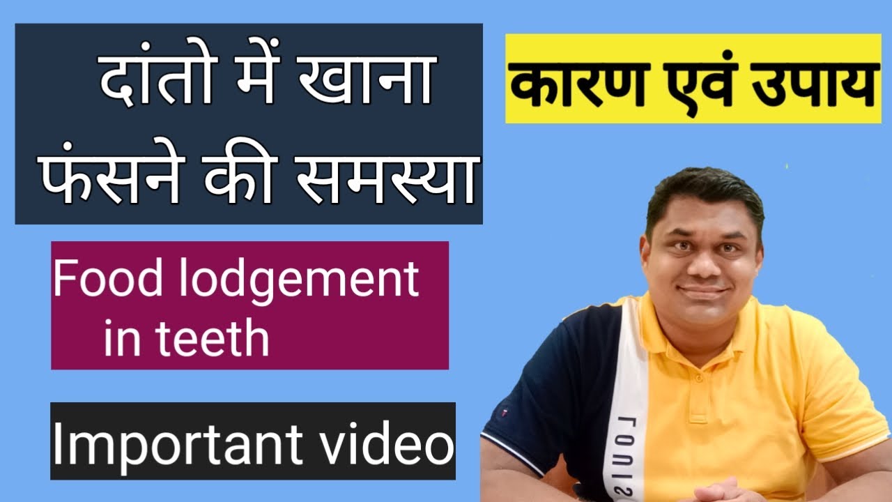 दातों में खाना फंसने की समस्या |Food Lodgement In Teeth |Danto Me Khana Fasne Ki problem & Solution