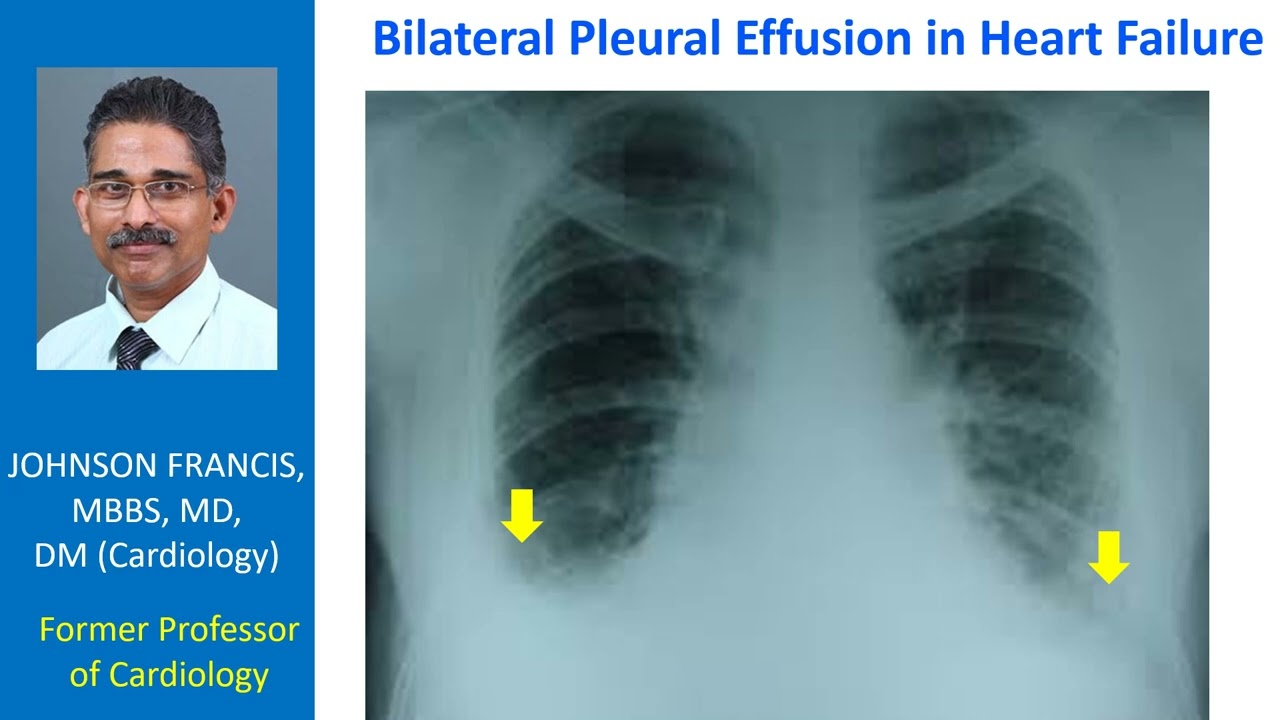 Bilateral Pleural Effusion in Heart Failure