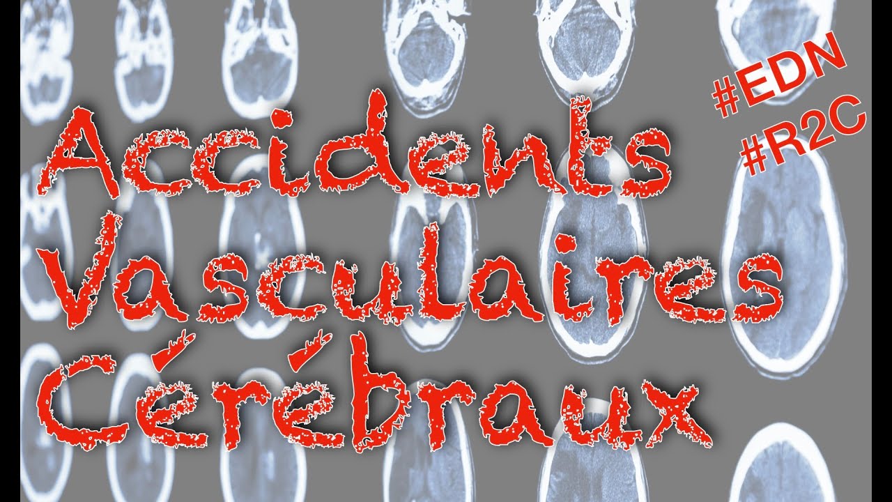 Accidents vasculaires cérébraux (item 340) : ce qu'il faut savoir pour l'EDN