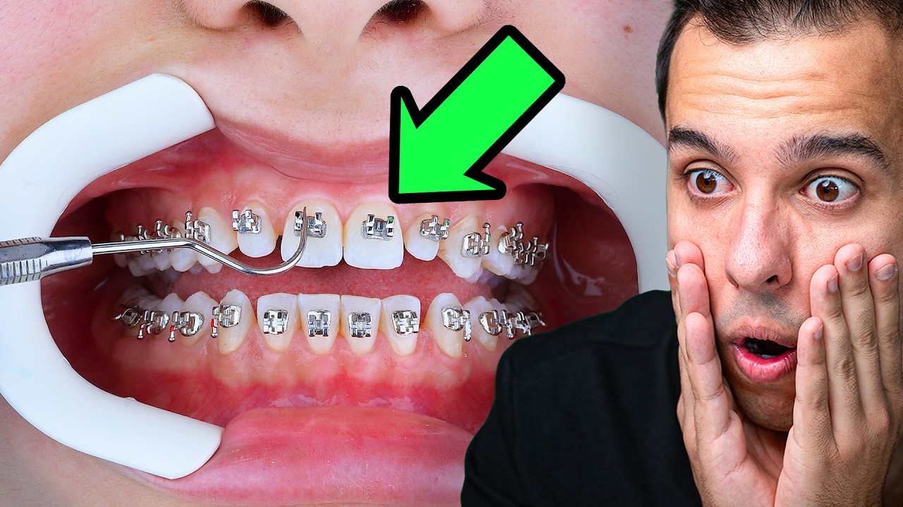 DİŞLERE TEL TAKMAK ! | Diş Teli Nasıl Takılır ?