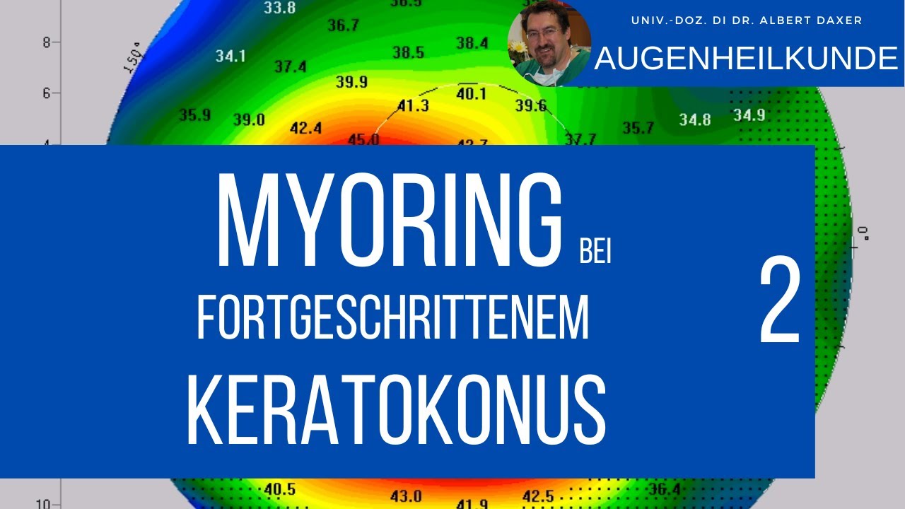 MyoRing Behandlung von sehr fortgeschrittenen Keratokonus Erkrankungen.