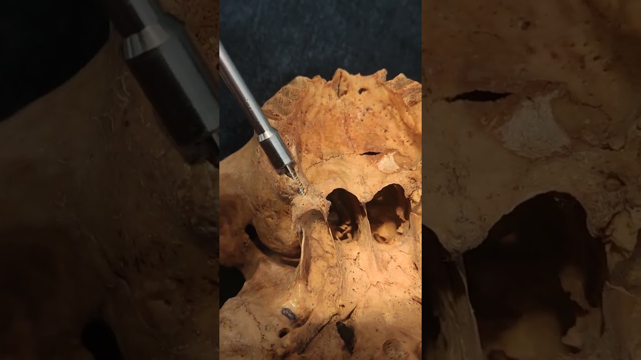 hands on... pterygoid Implant placement
