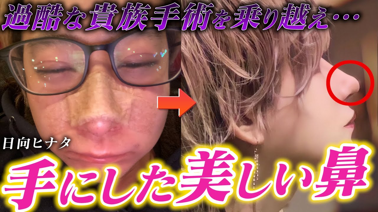 【貴族手術】日向ヒナタが整形で手にした新たな顔とは！整形手術の全貌を語る！