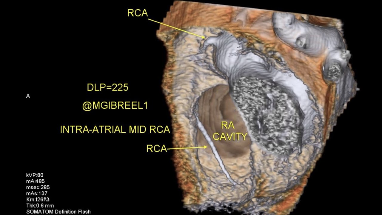 State of the art ; INTRA-ATRIAL MID RCA , RA cavitary course