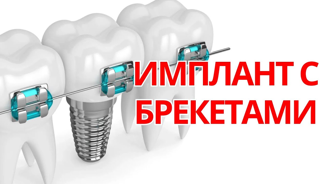 ИМПЛАНТАТЫ + БРЕКЕТЫ | 7 советов об имплантации. Взгляд ортодонта.