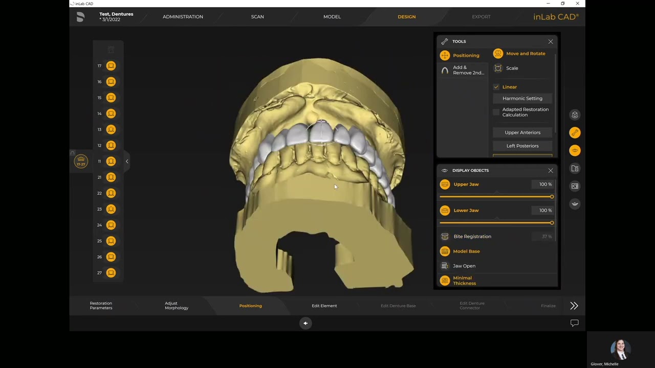 inLab SW22 Complete over Natural Dentures