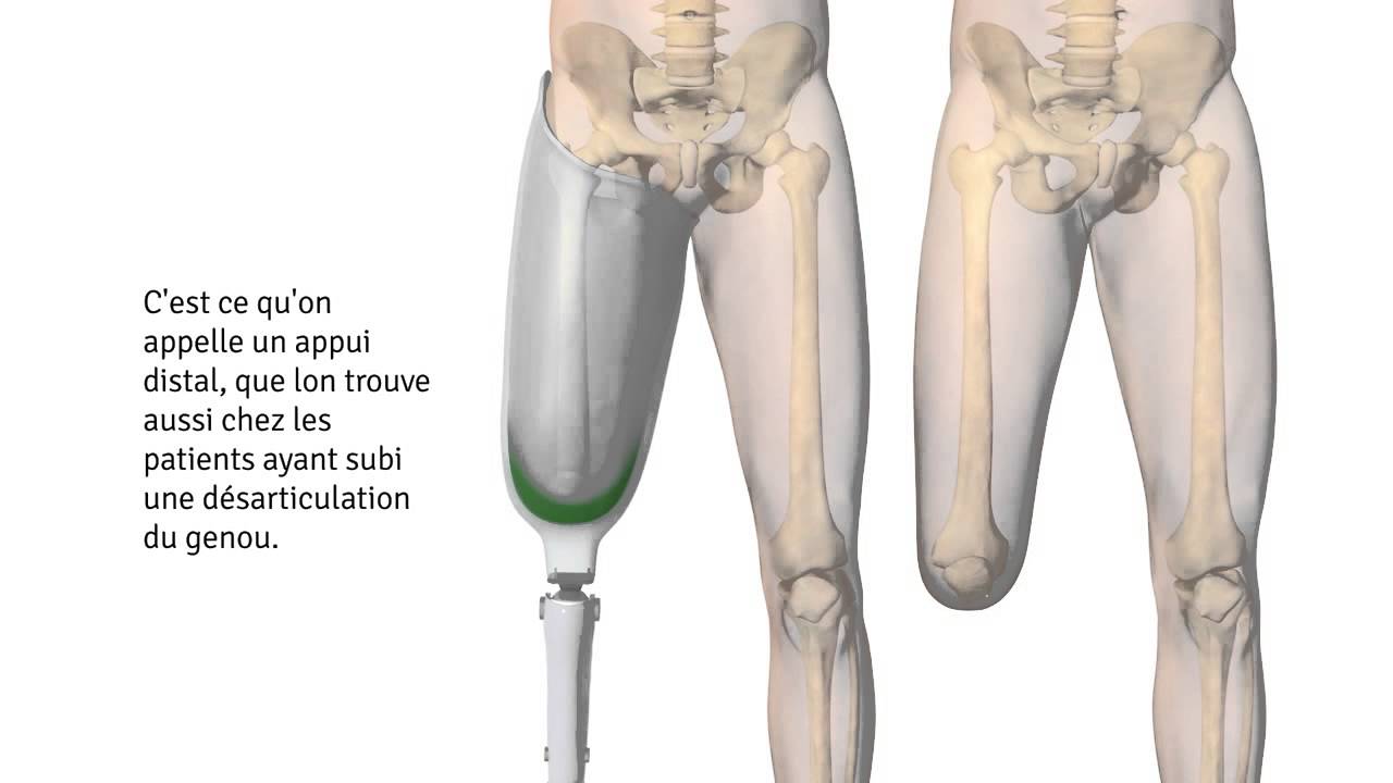 Implant Keep Walking La solution pour  l´amputé transfémoral