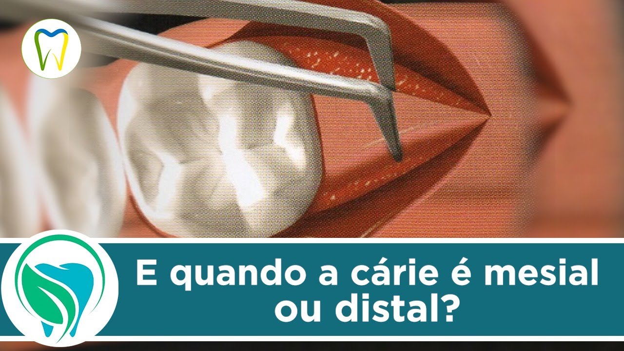Aumentos de coroa clínica em faces proximais