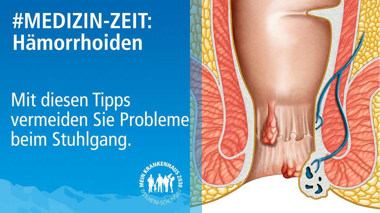 #Medizinzeit: Was tun bei Hämorrhoiden?: Stuhlgang Probleme vermeiden und Hämorrhoiden erkennen