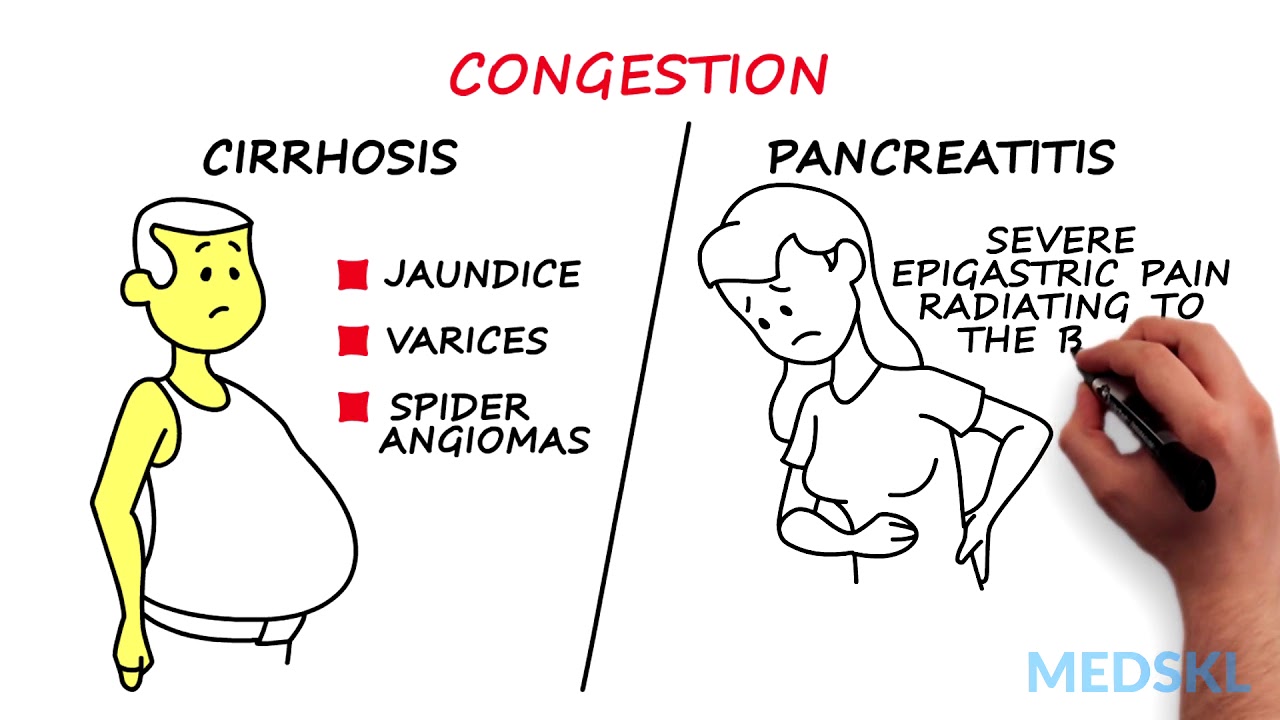 Splenomegaly: Remember the 3 primary causes with CIP