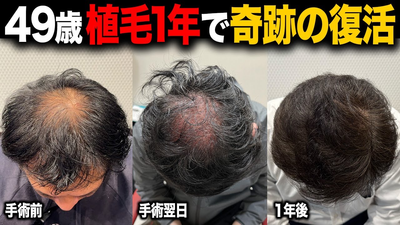 【植毛1年の軌跡】49歳 頭頂部がここまで復活するとは思わなかった...。