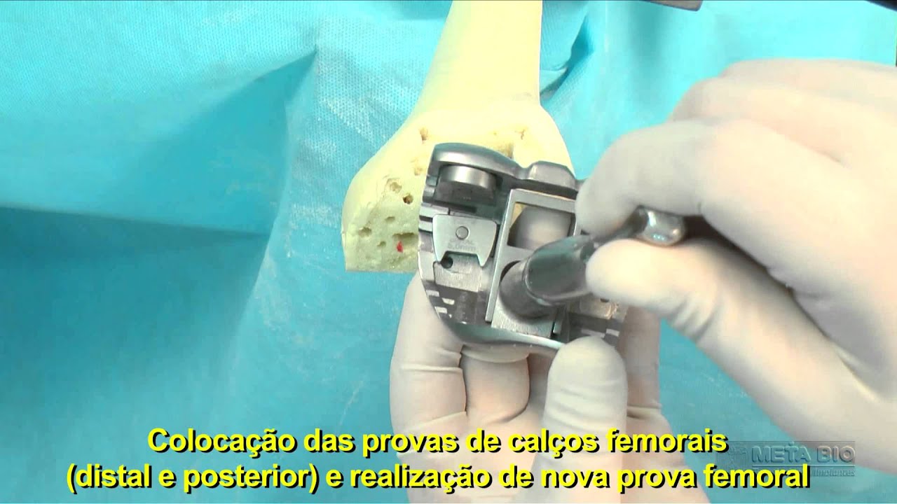 Técnica Cirúrgica para Artroplastia Total de Joelho - Revisão