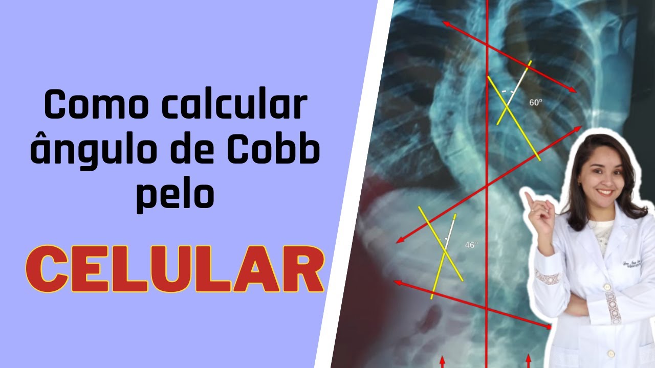 COMO CALCULAR O ÂNGULO DE COBB PELO CELULAR | ESCOLIOSE