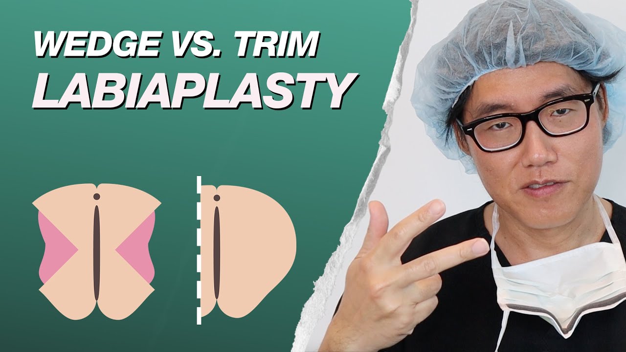 What is the Difference Between A Wedge Labiaplasty Vs. Trim Labiaplasty?