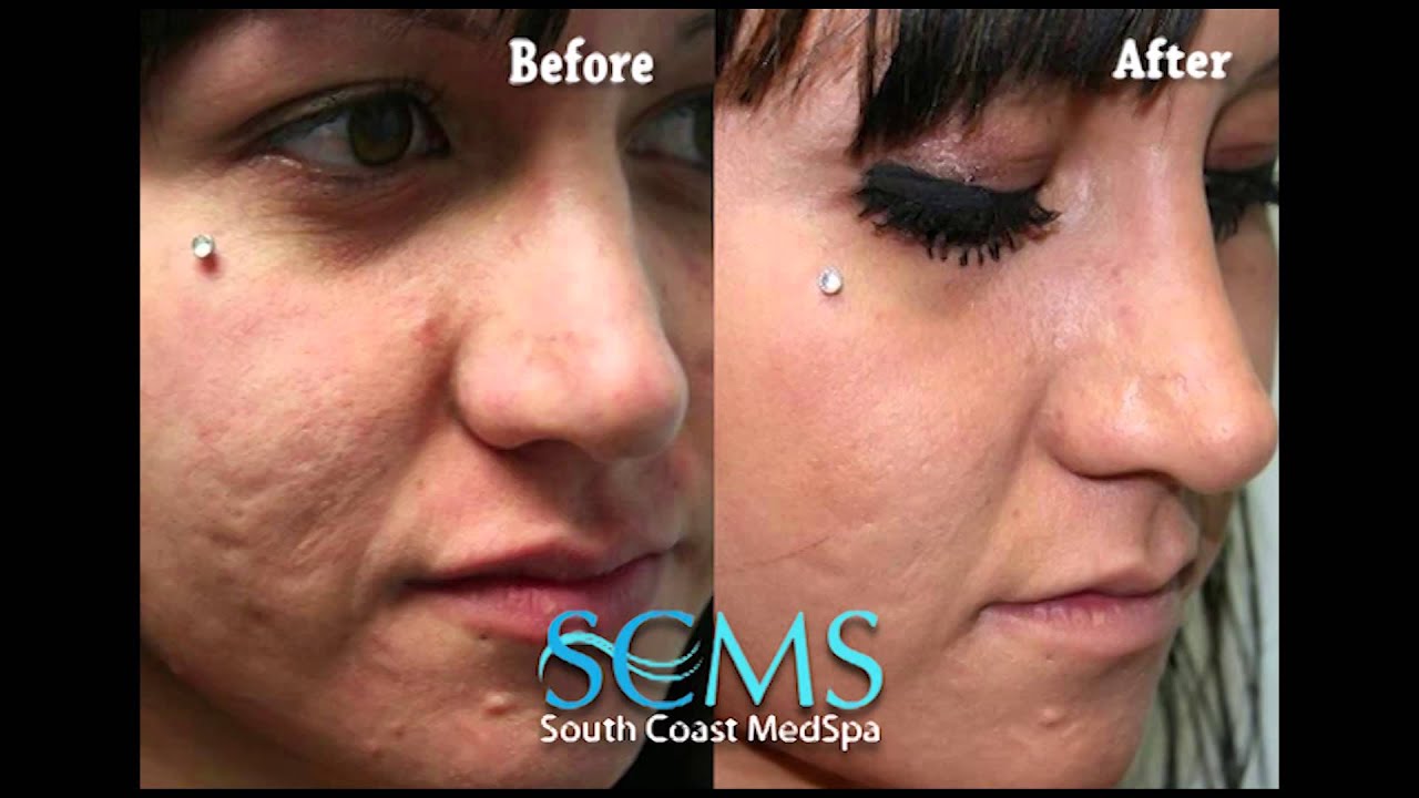 Before/After Female Laser Acne Scar Removal Orange County