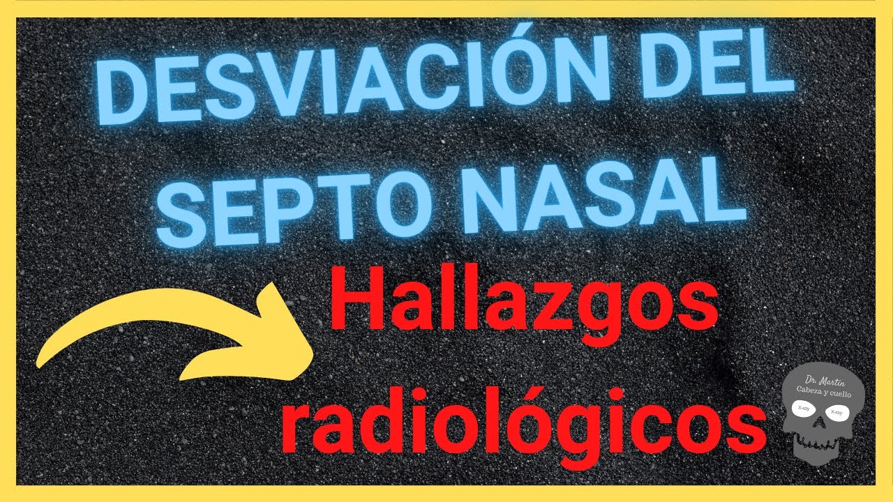 DESVIACIÓN DEL TABIQUE NASAL 👃(así se ve en tomografía)