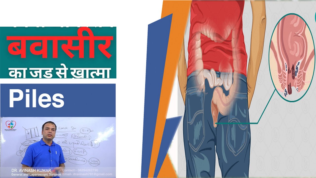 Dr.Avinash Kumar से जानें बवासीर (Piles) को जड़ से खत्म कैसे करें / Covid-19 Stay Home Stay Safe