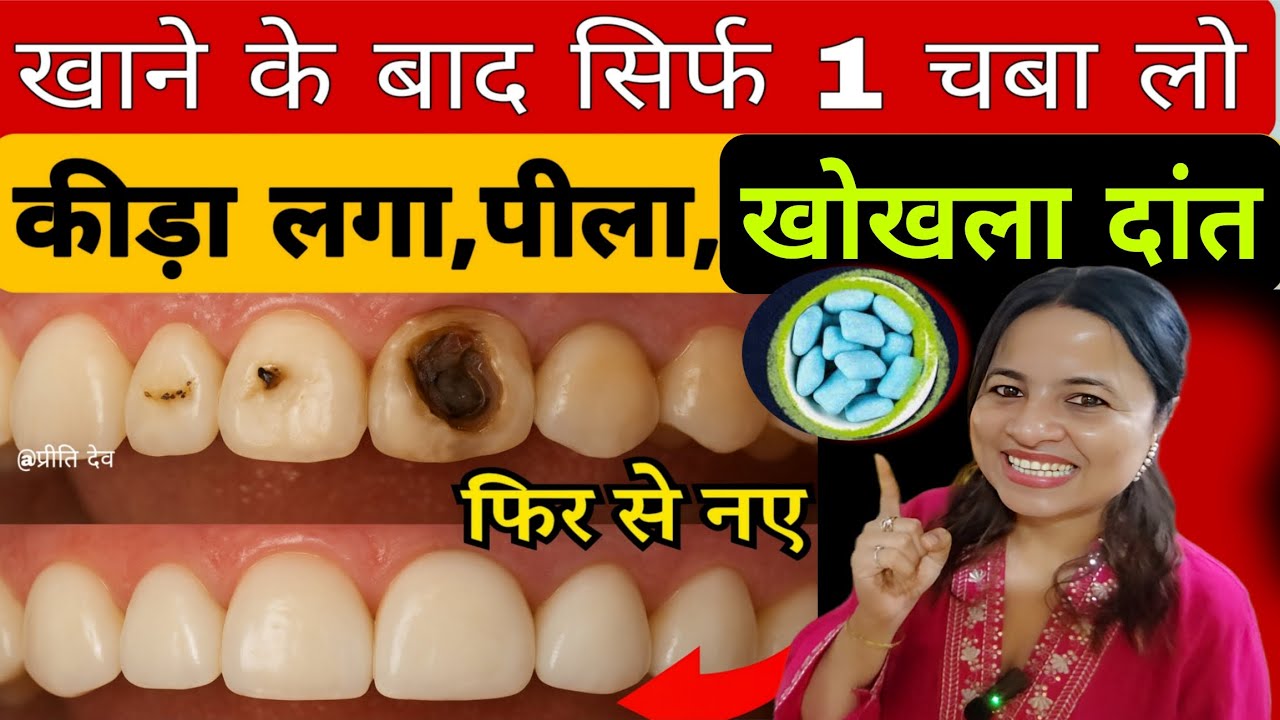 सुबह शाम  2 चबा लो (Sugar Free Gum) कीड़ा लगा,पीला,खोखला दांत फिर से नया #Teethcavity 