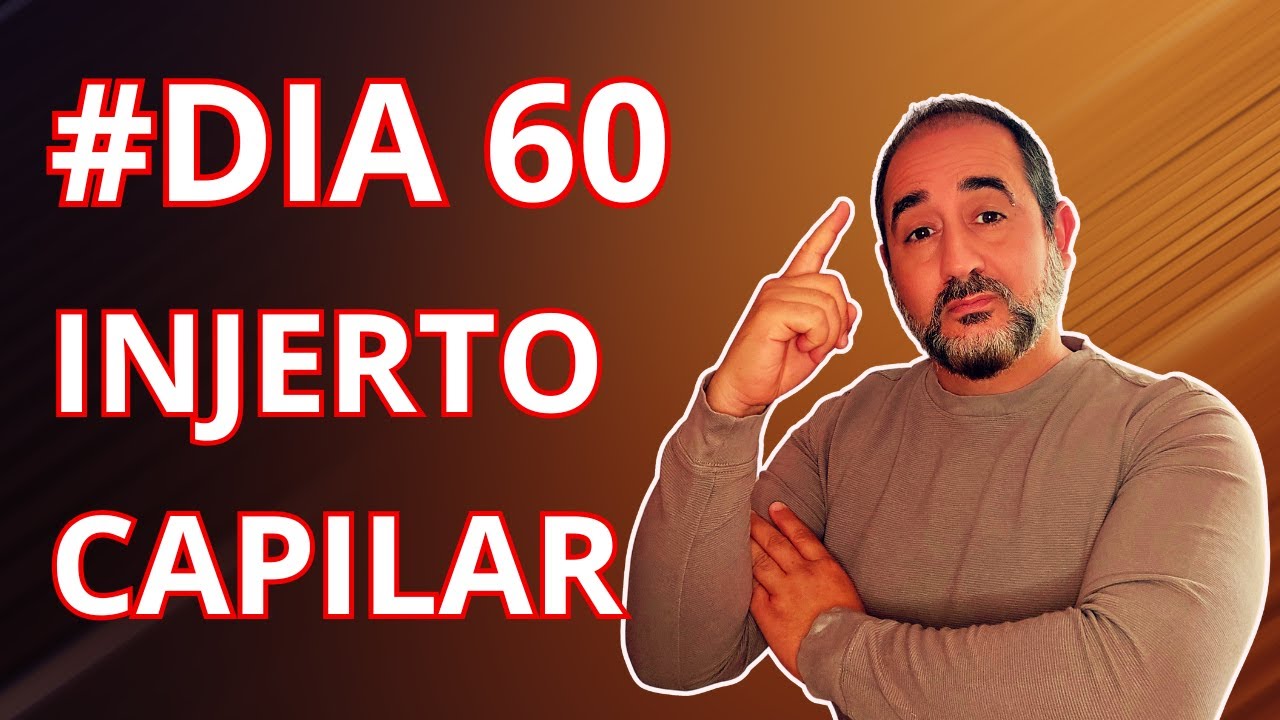 ¿Qué Pasa 60 Días Después de un Injerto Capilar? Mi Experiencia Real