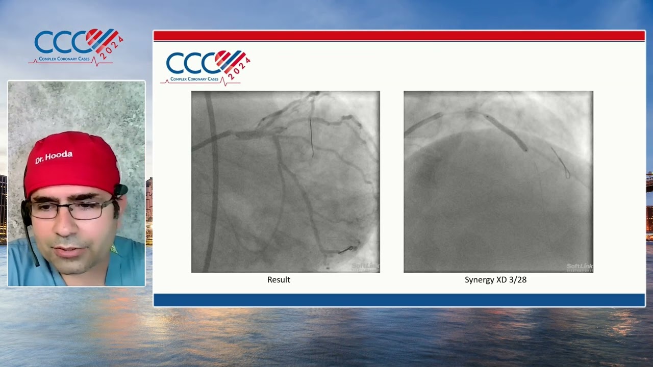 Amit Hooda, MD   Case #3  My Worst Bifurcation Complication