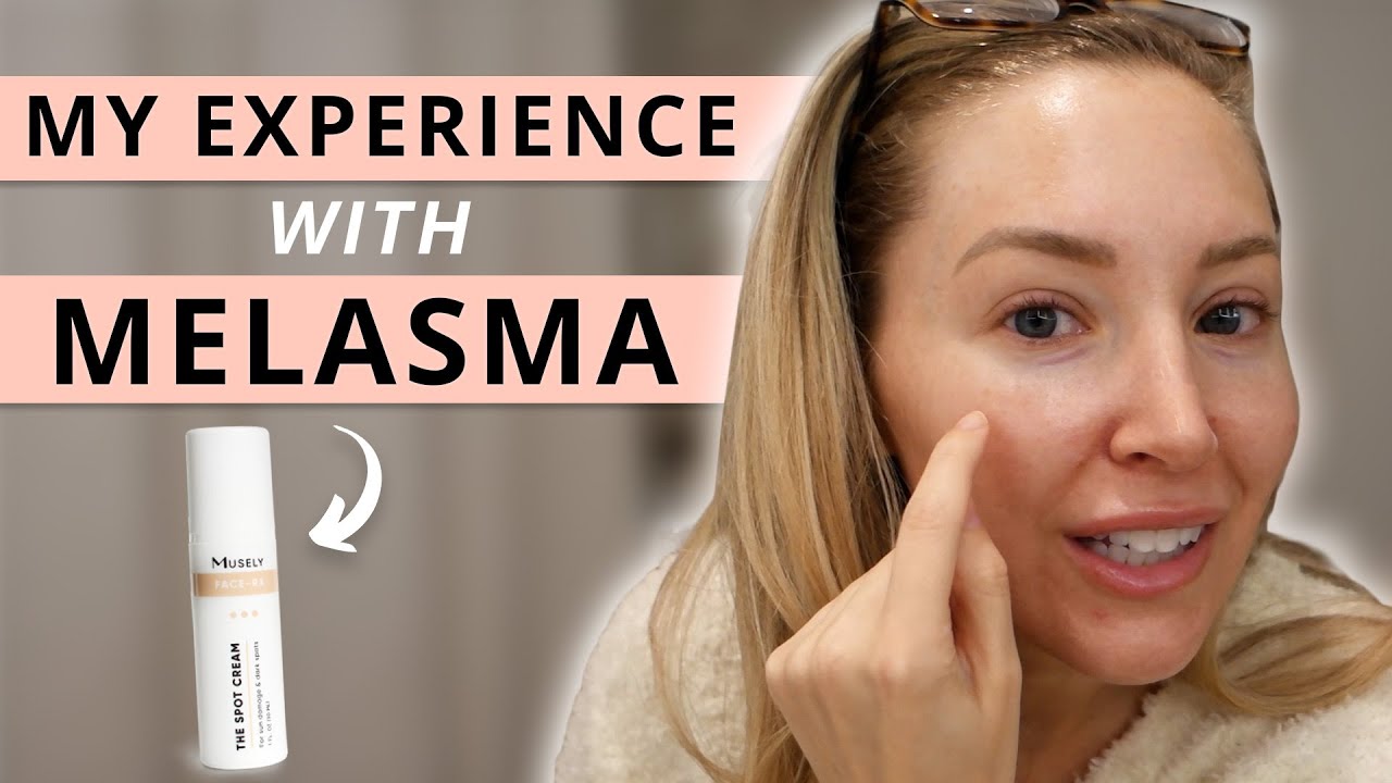 My Experience with Melasma | How I am Getting Rid of Melasma