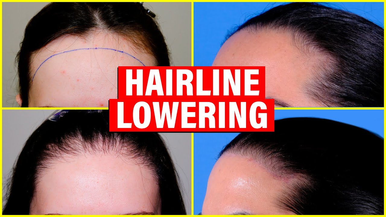 Hairline Lowering: Hair Transplant vs. Surgical Hairline Advancement