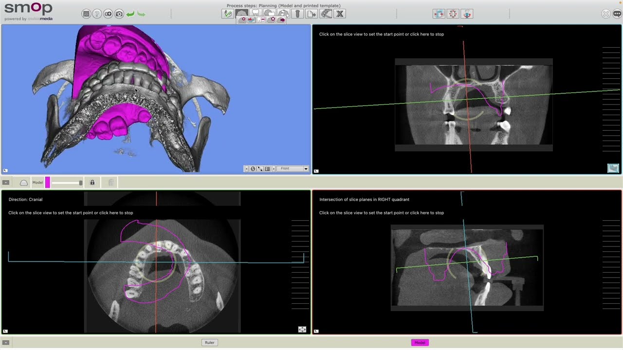 Smop: How to Align STL File with CBCT Scan
