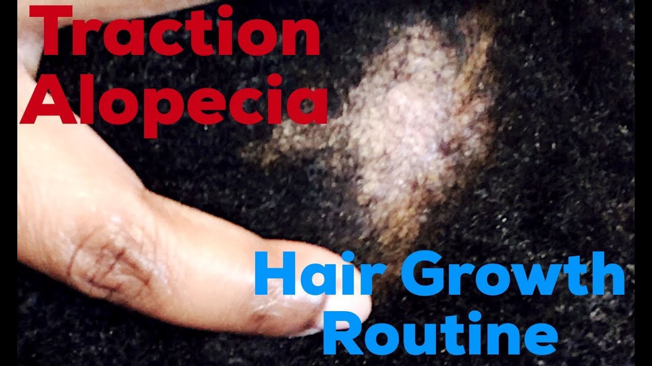 Traction Alopecia//Hair Growth Routine