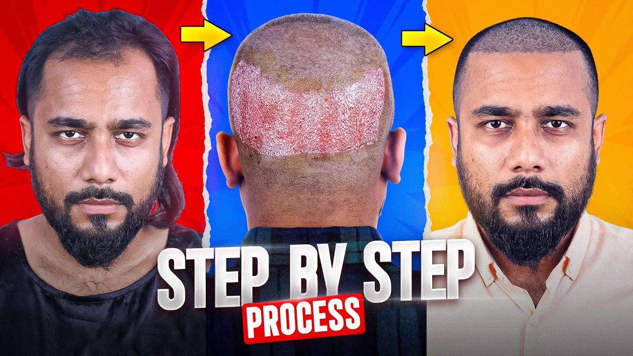 আমার Hair Transplant করার Step by Step সম্পূর্ণ প্রসেস । কত টাকা খরচ হয় ?  কতগুলো চুল লাগাতে হয় ?