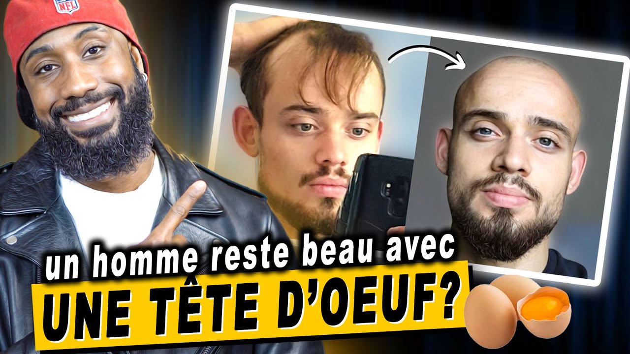 Est-ce qu’un HOMME reste beau avec une CALVITIE ? ( balding transformation )
