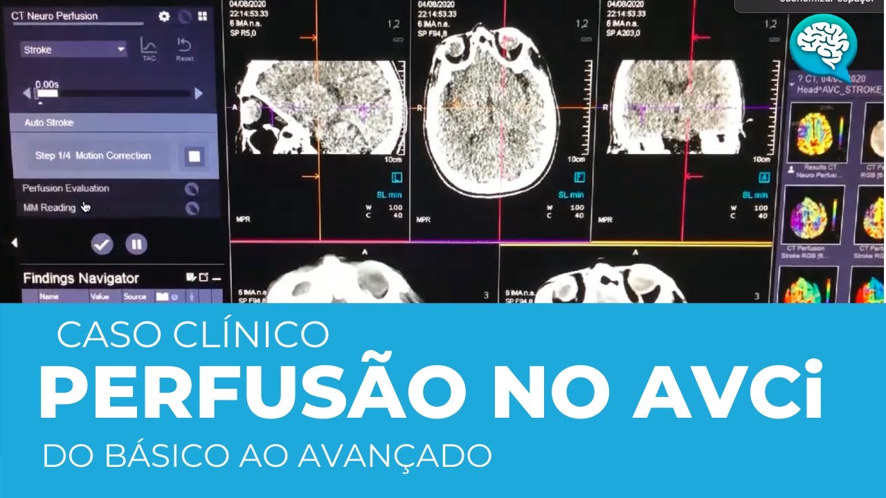 PERFUSÃO NO AVCi : DO BÁSICO AO AVANÇADO