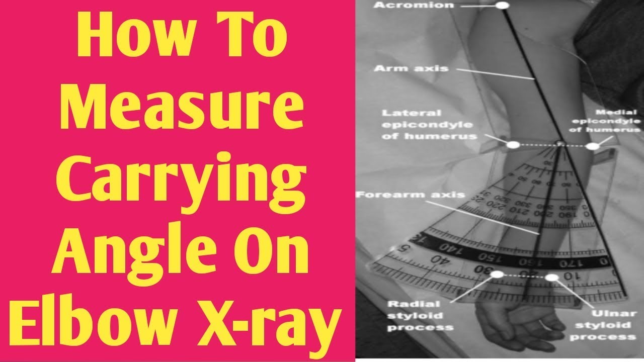 How to measure carrying angle on elbow X-ray