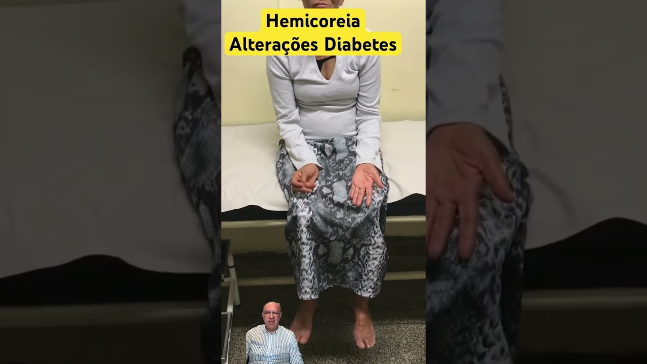 HEMICOREIA-HEMIBALISMO EM PACIENTE COM HIPERGLICEMIA