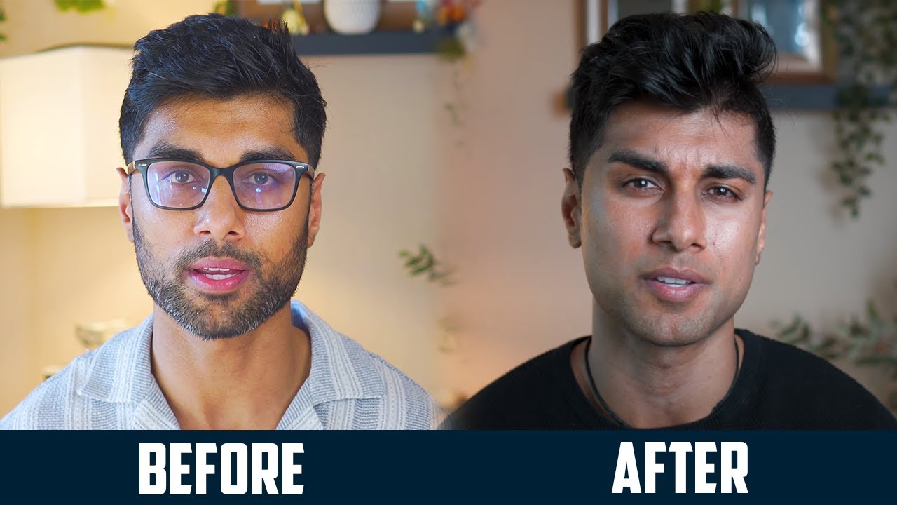 How Shame Drove Me to Erase My Beard with Laser Hair Removal