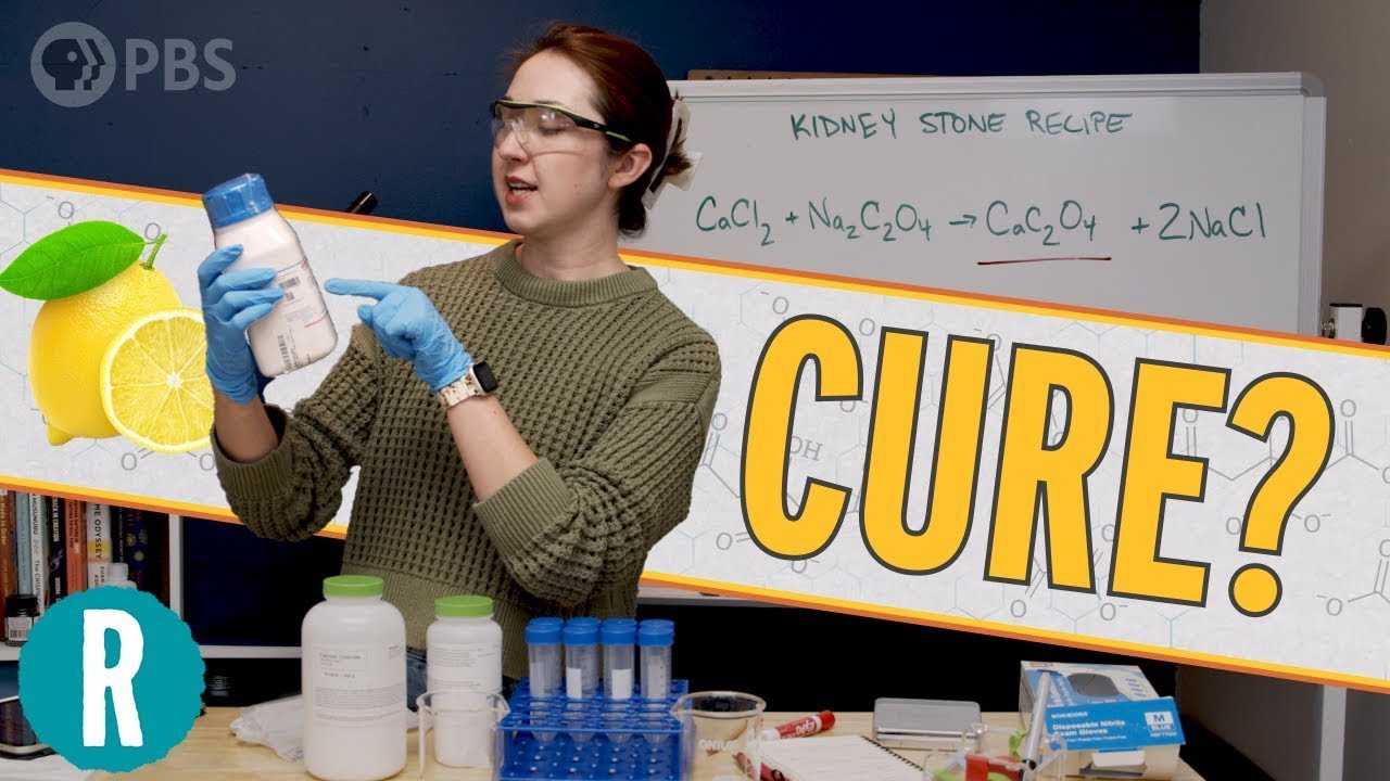 I Destroyed Homemade Kidney Stones with Lemon Juice