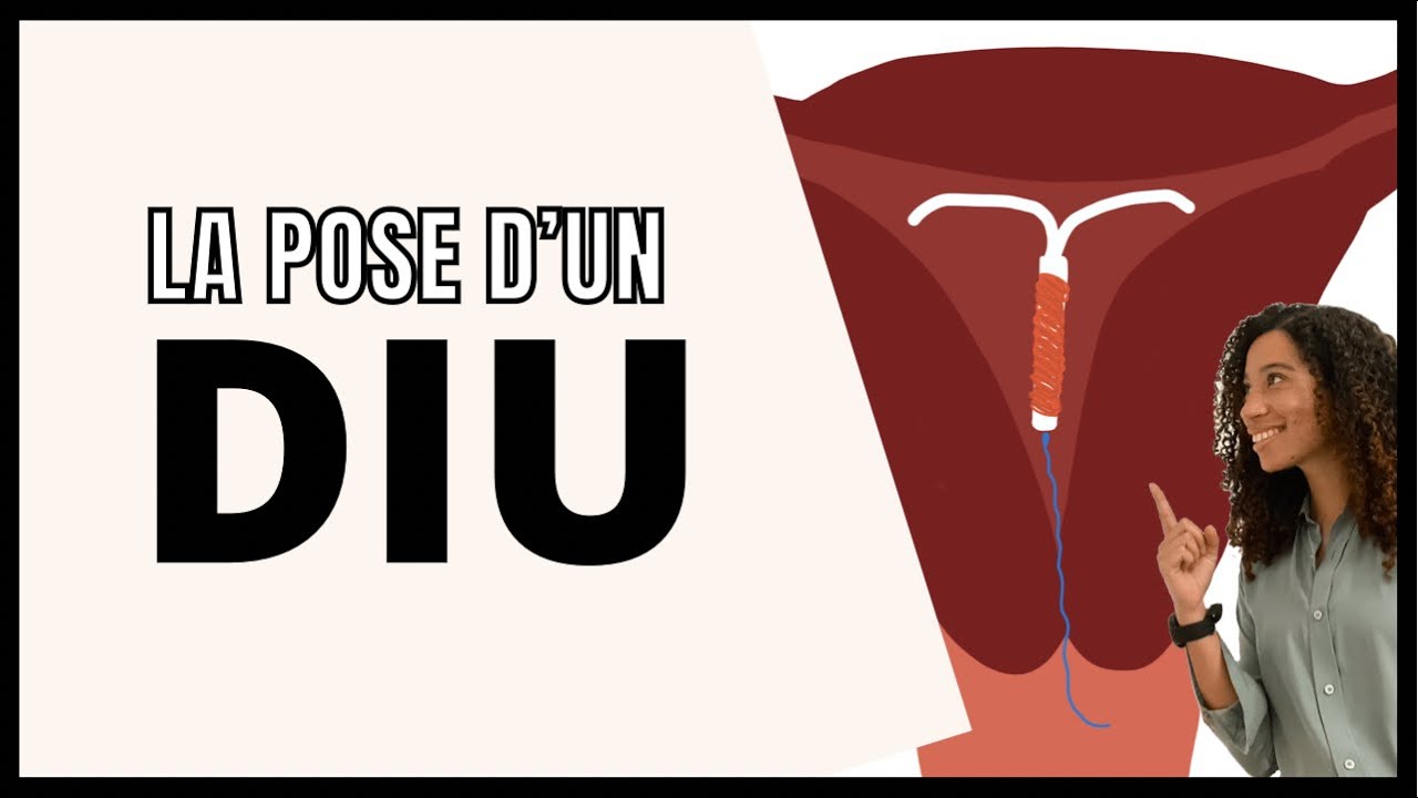 Comment se passe la pose d’un stérilet (DIU : Dispositif Intra Utérin)