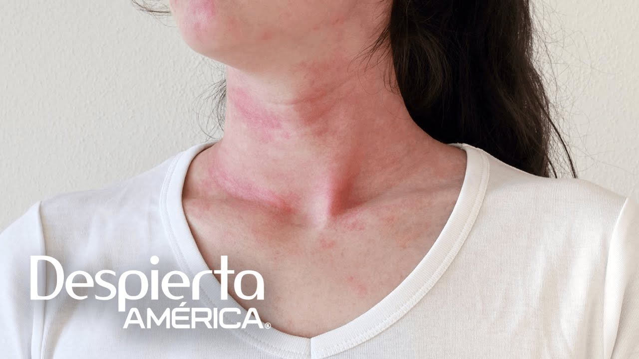 Vacuna de AstraZeneca contra covid desarrolla ligeras reacciones al&eacute;rgicas | Dr. Juan
