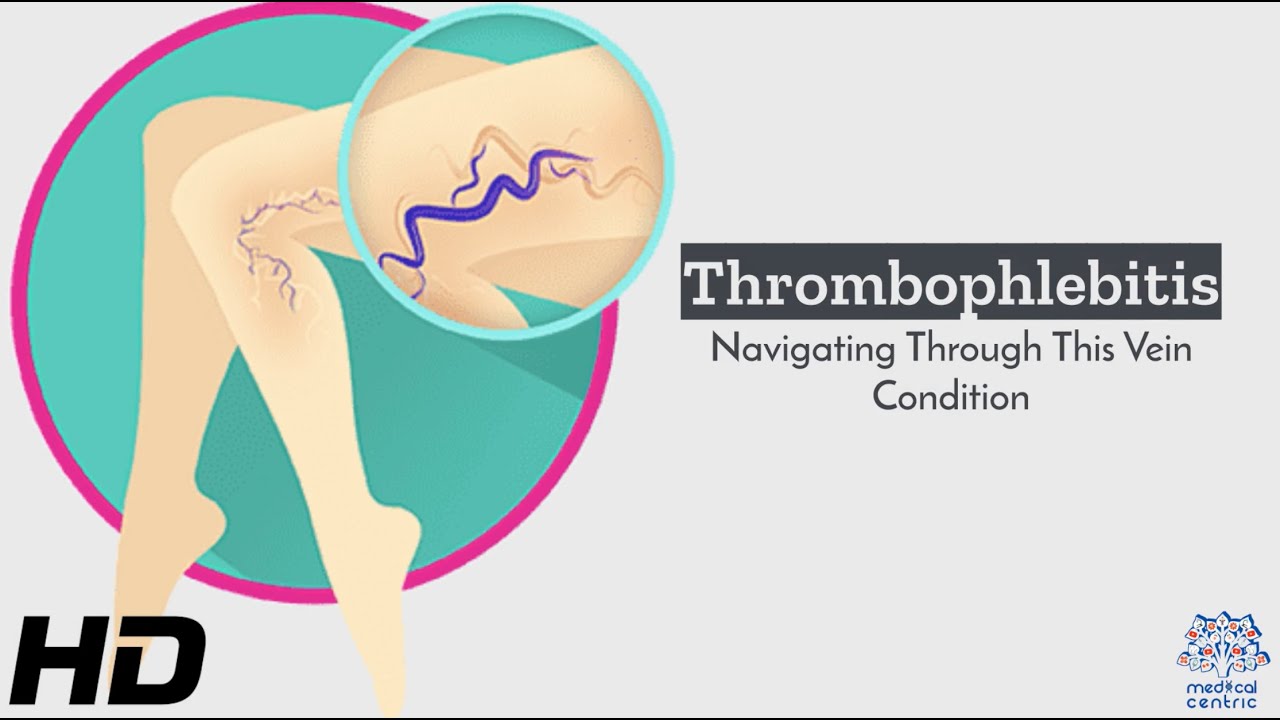 Thrombophlebitis 101: Navigating the Challenges of Vein Conditions