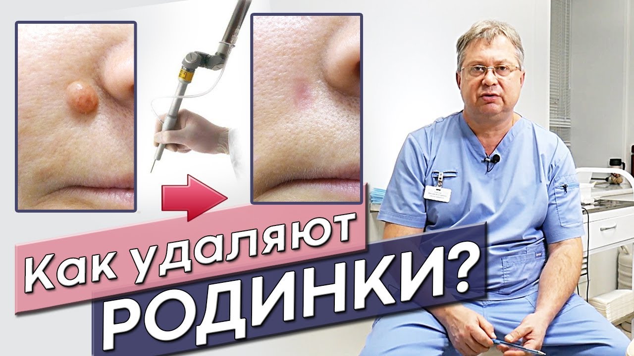 Удаление родинок Рязань. Самые лучшие методы