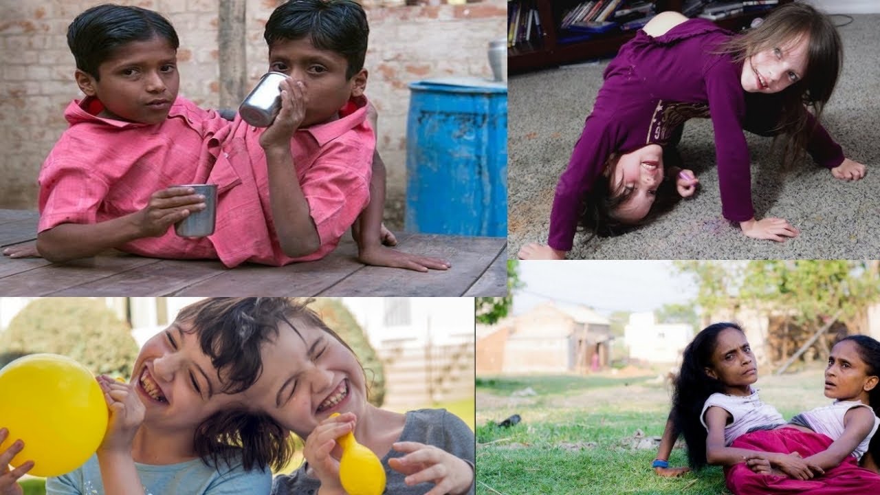 Top 10 Unusual Conjoined Twins You Won't Believe Exist.#factzone #ConjoinedTwins #Top10