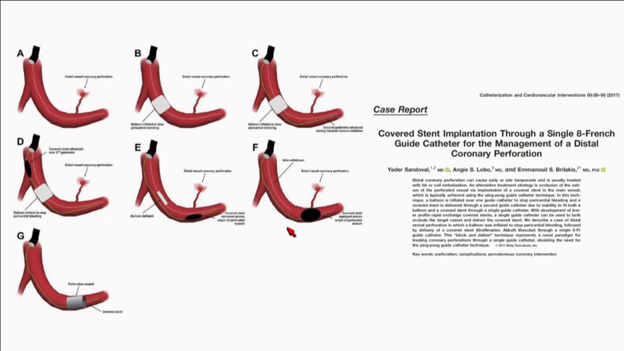How to Approach Coronary Stent Loss - Emmanouil S. Brilakis, MD, PhD