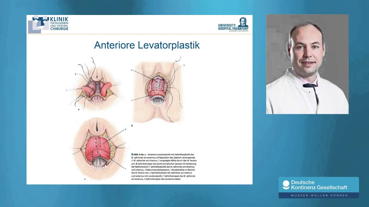 N. Habbe: Stuhlinkontinenz - Diagnose, Risiken und Therapien