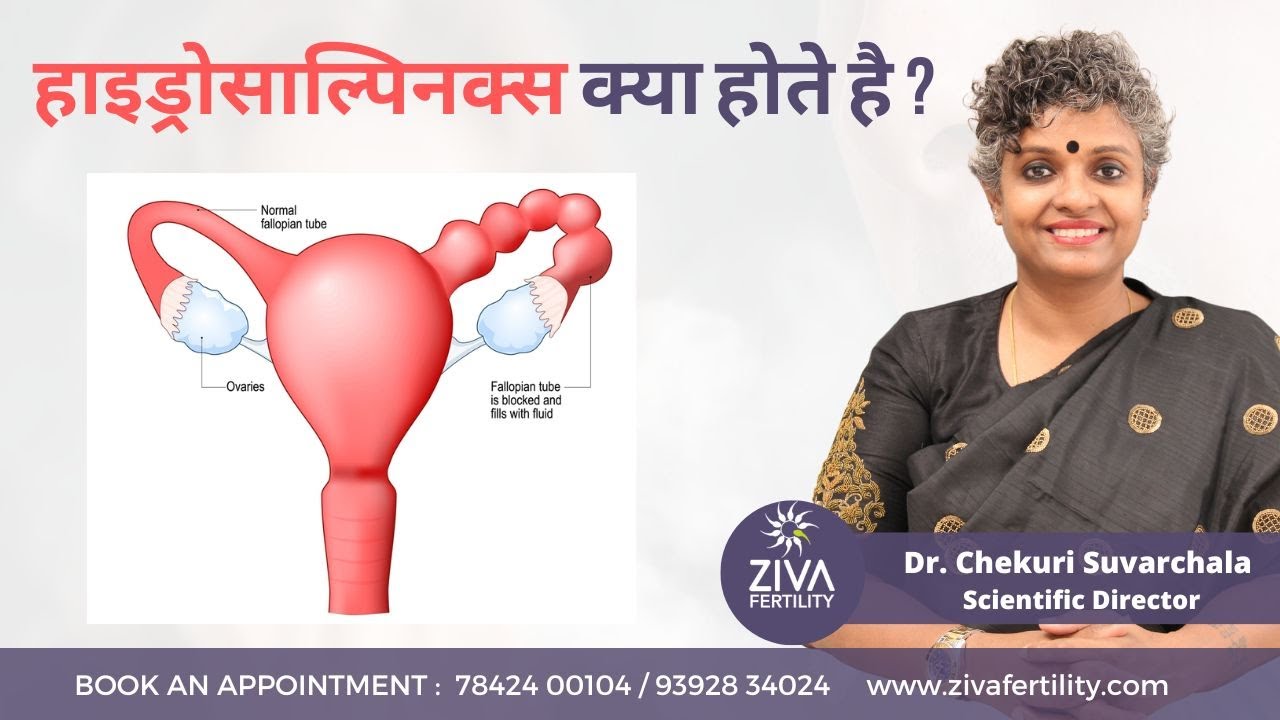 Hydrosalpinx Treatment || फैलोपियन ट्यूब में रुकावट || Dr Chekuri Suvarchala || Ziva Fertility