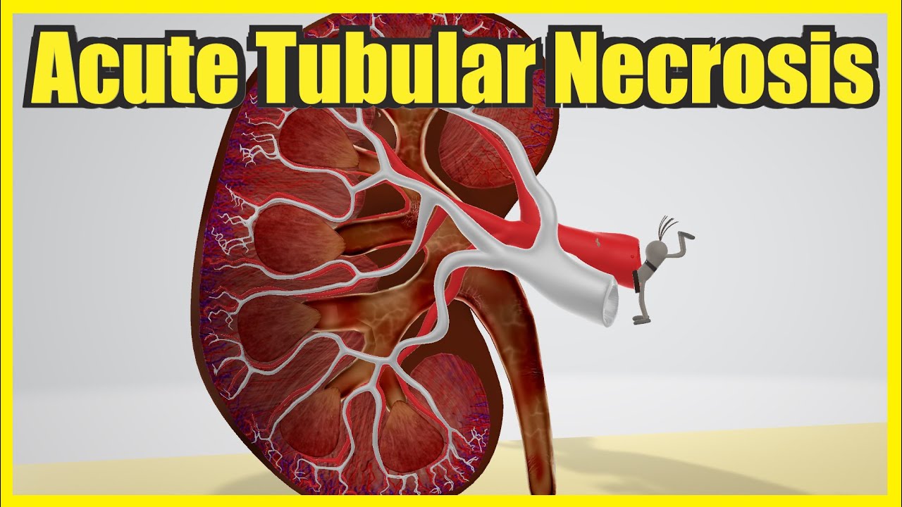 Acute Tubular Necrosis (Mnemonic for the USMLE)