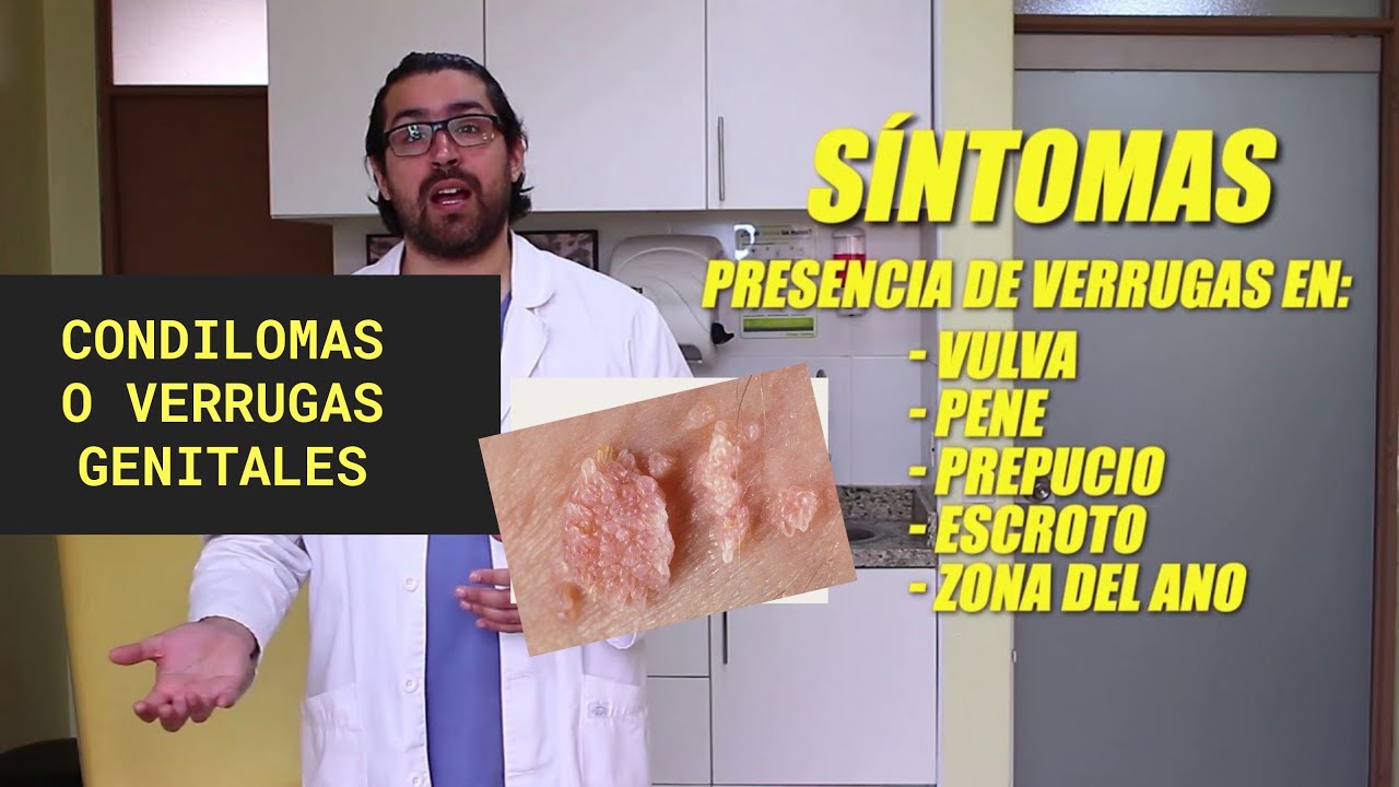 Verruga Genital o Condiloma Acuminado | Dr Ego