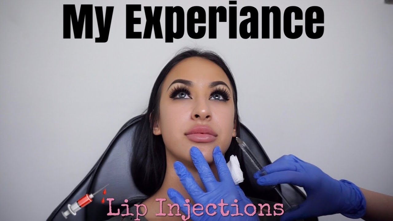 My experience with lip fillers