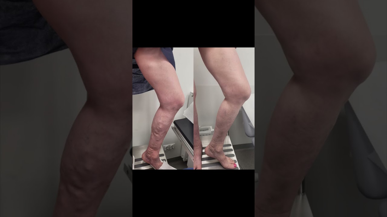 Zaawansowane żylaki kończyn dolnych - jak leczyć? Odpowiada doktor Jan Świercz z Doppler Instytut