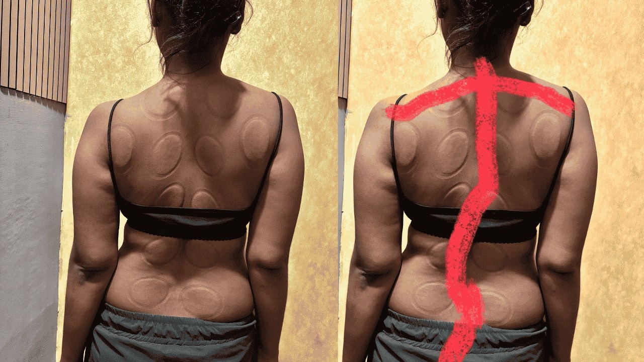 Scoliosis Treatment  Chiropractic Adjustment | Dr Jeetu Mishra